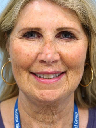 Endoscopic Browlift, Facial Fat Graft, Full Facelift, Fractional CO2 Laser* — Before
