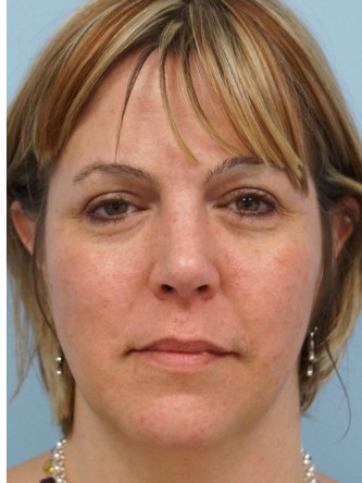Cheek Augmentation using Voluma* — Before