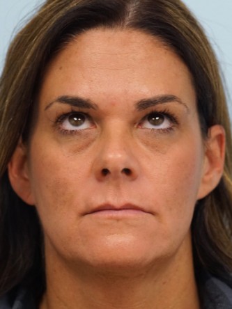 Glabellar Botox and Filler* — After