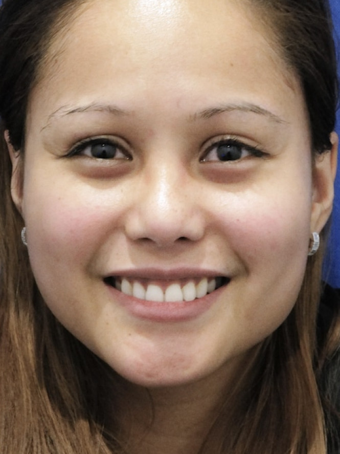 Eyelid Crease Deepening — After