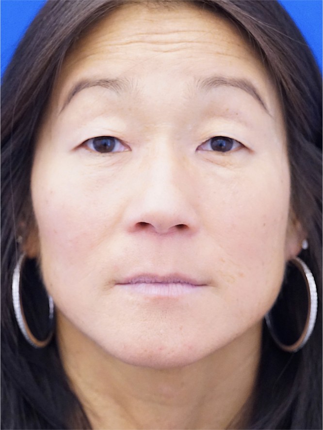 Asian Crease Creation — Before