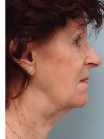 Facelift, Necklift, Platysmaplasty, ERB:YAG Laser Resurfacing* — Before