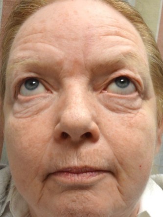 Visual Field Deficit – Eyelid Excess Skin4* — Before