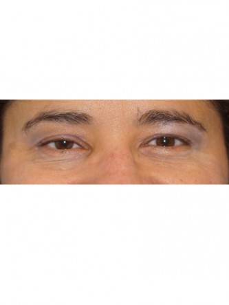Right Ptosis Repair* — Before