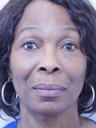 Tear Trough Under Eye Enhancement — After