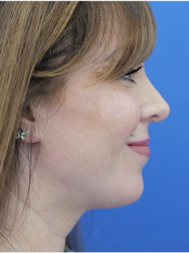 Dorsal Preservation and Refinement — After