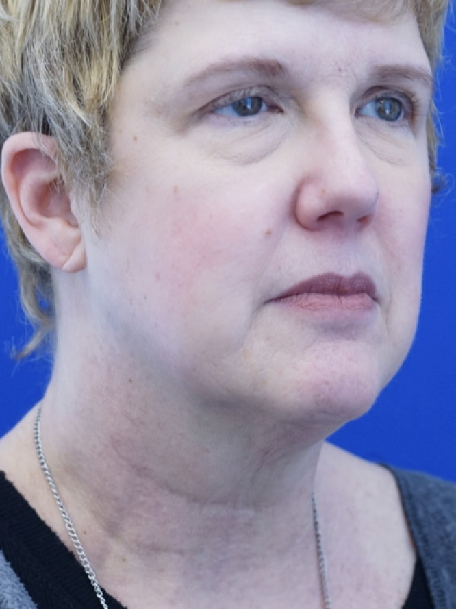 Facelift Platysmaplasty with Subplatysmal Lipectomy — Before