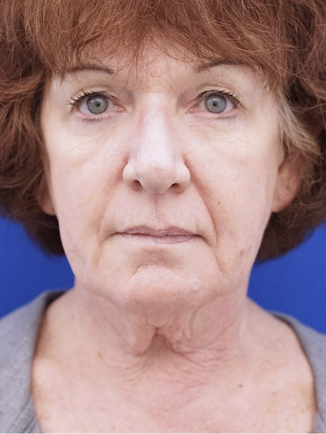 Neck Loose Skin — Before