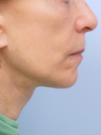 Full Face and Necklift, Upper and Lower Eyelid, Browlift* — After