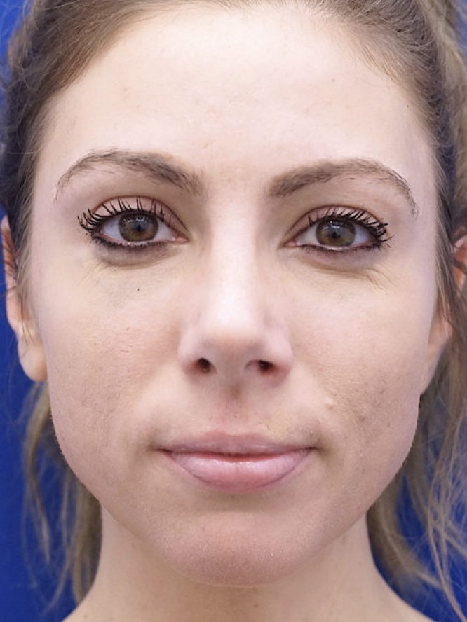 Endonasal Dainty Nose — After