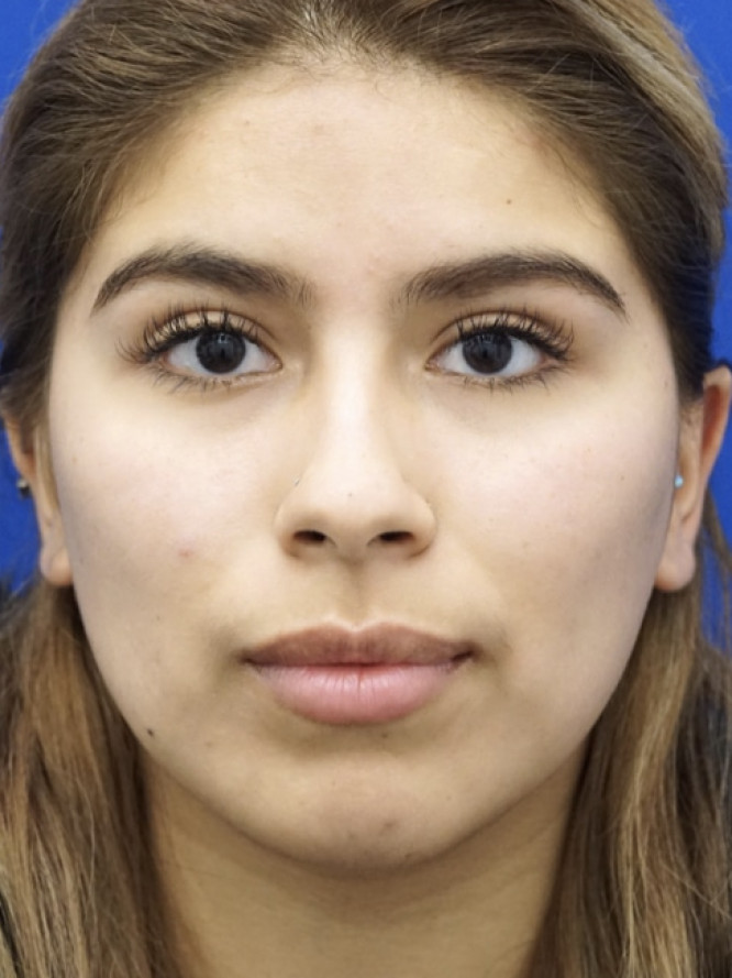 Cheek Contouring — After