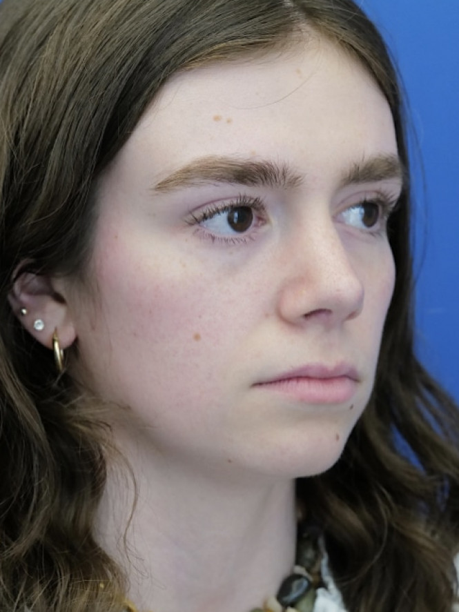 Preservation Rhinoplasty1 — After
