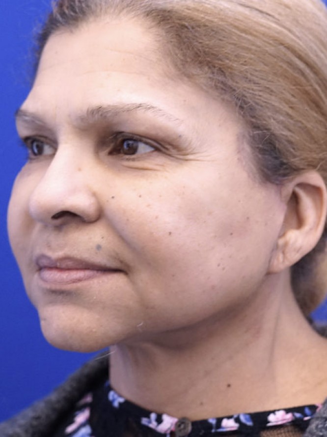 Necklift and Liposuction — After