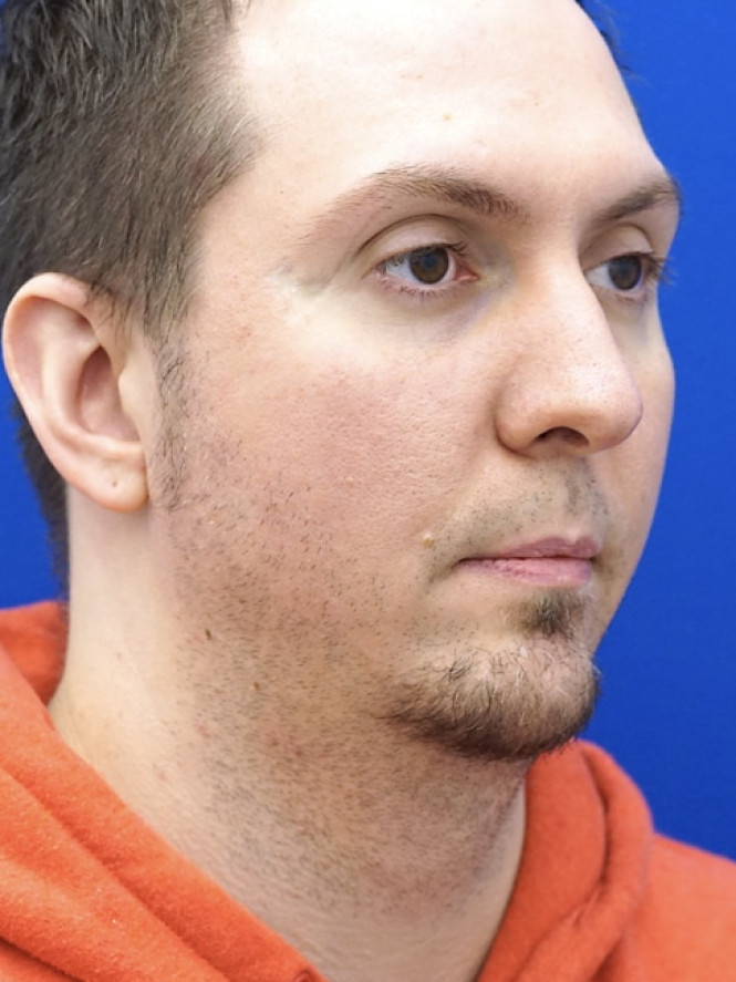 Lower Facial Contouring — Before
