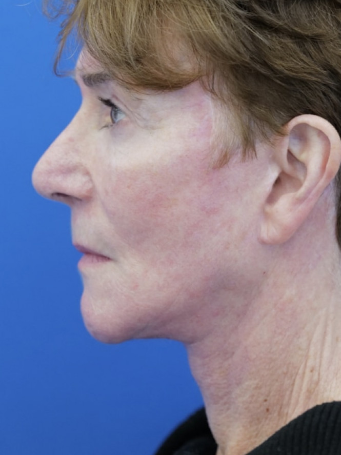 Deep Plane Facelift and Eyelid Lift — After
