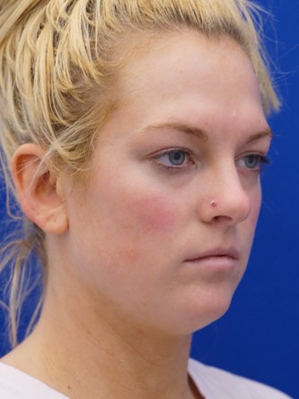 Restylane Silk Equalizes Lip Volume* — Before