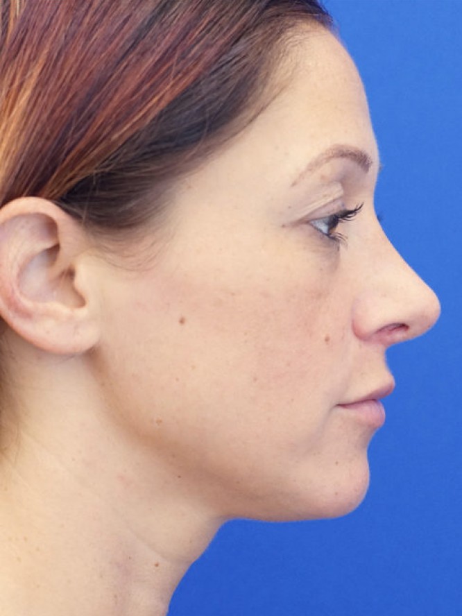 Dainty Nose — After