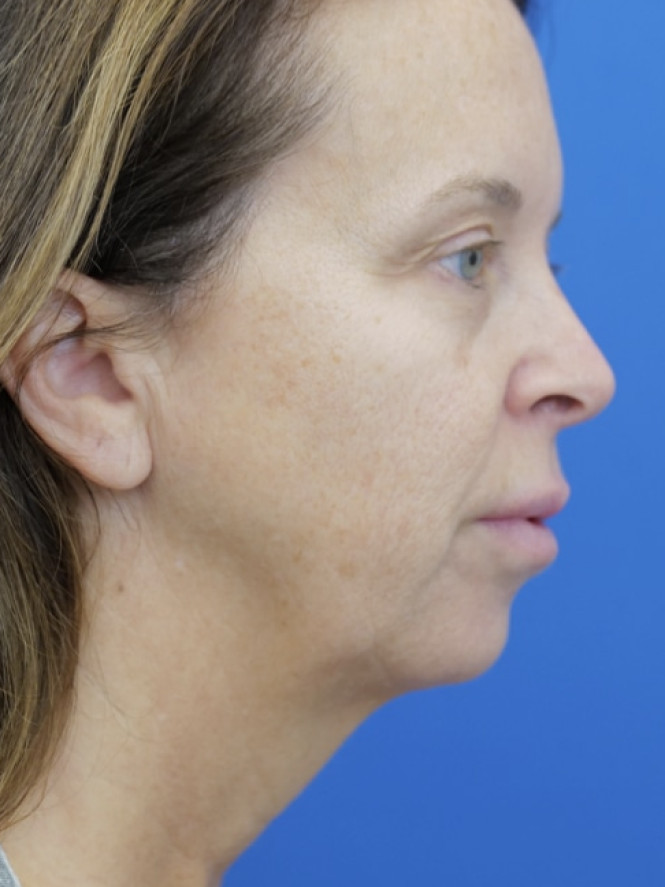 Jowling and Skin Laxity — Before