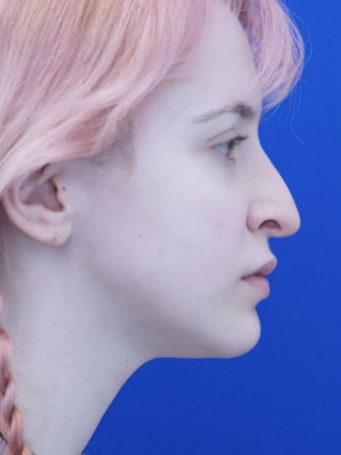 Long Droopy Tip — Before
