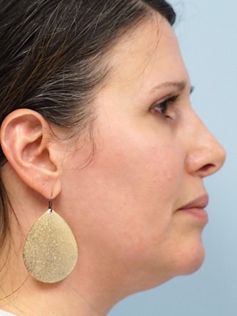 Tip Asymmetry and Hanging Columella* — Before
