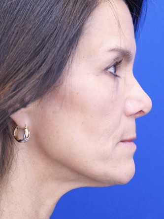 Nasal Tip Deformity — After