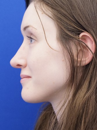 Nasal Profile Irregularity — After
