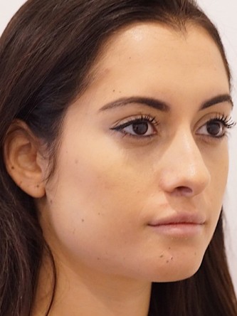 Restylane Silk to Volumize Lower Lip* — After