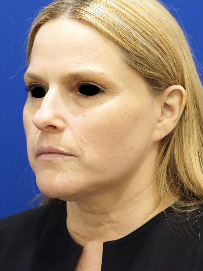 Deep Plane Lower Facelift and Platysmaplasty — Before