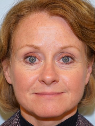 Lower Eyelid Excess Fat Pad1* — Before