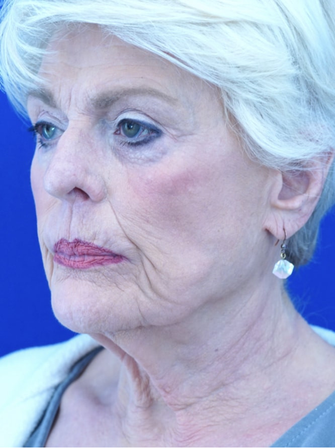 Deep Plane Lift and Platysmaplasty — Before