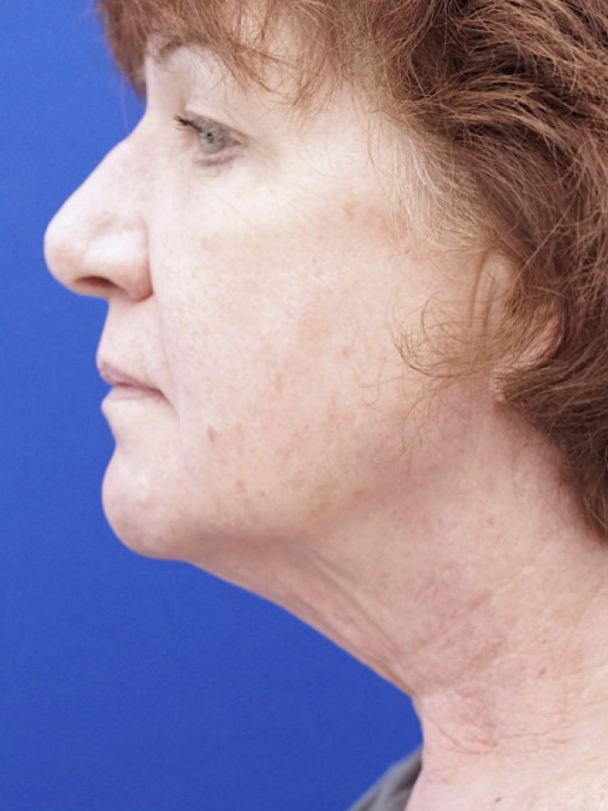 Neck Loose Skin — Before