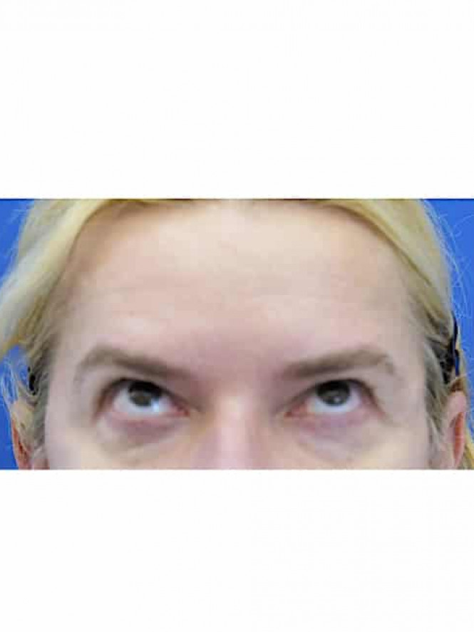 Cat Eye Blepharoplasty Browlift — Before