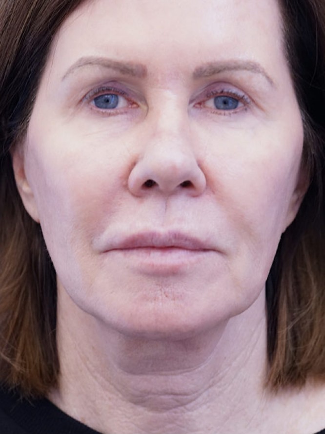 Secondary Lift and Facial Fat Grafting — Before