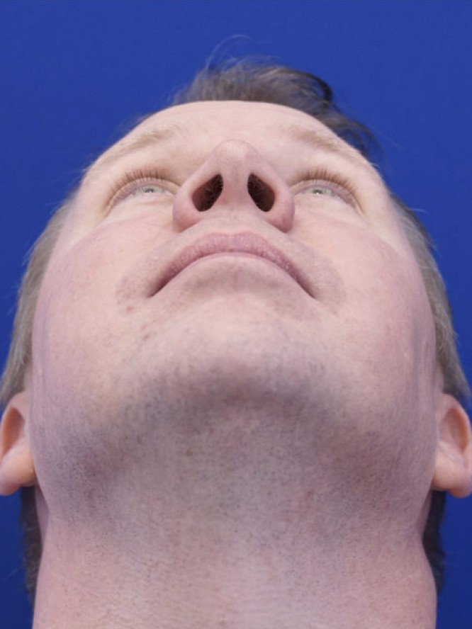Mild Nasal Deviation — After