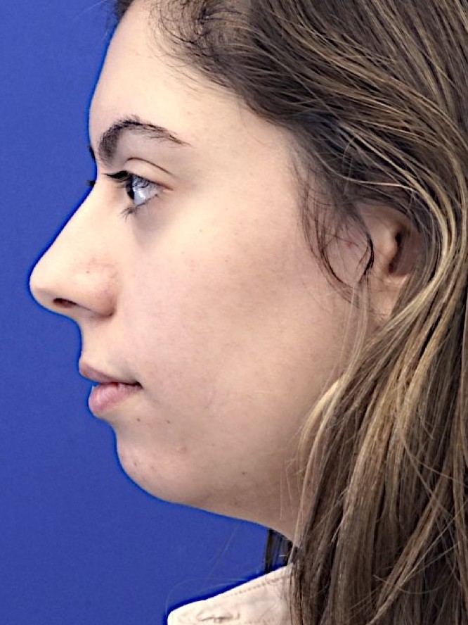Hump Reduction and Chin Projection — Before