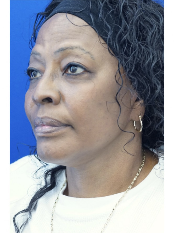 Necklift Platysma Suspension and Liposuction — After