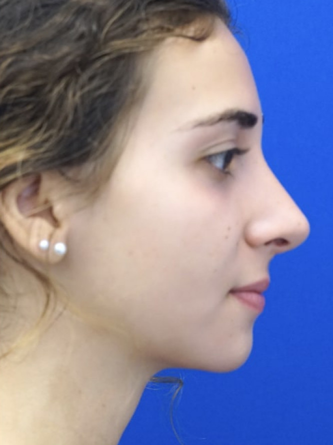Classic Tension Nose — After