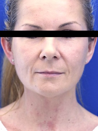 Upper Lip Shortening — Before