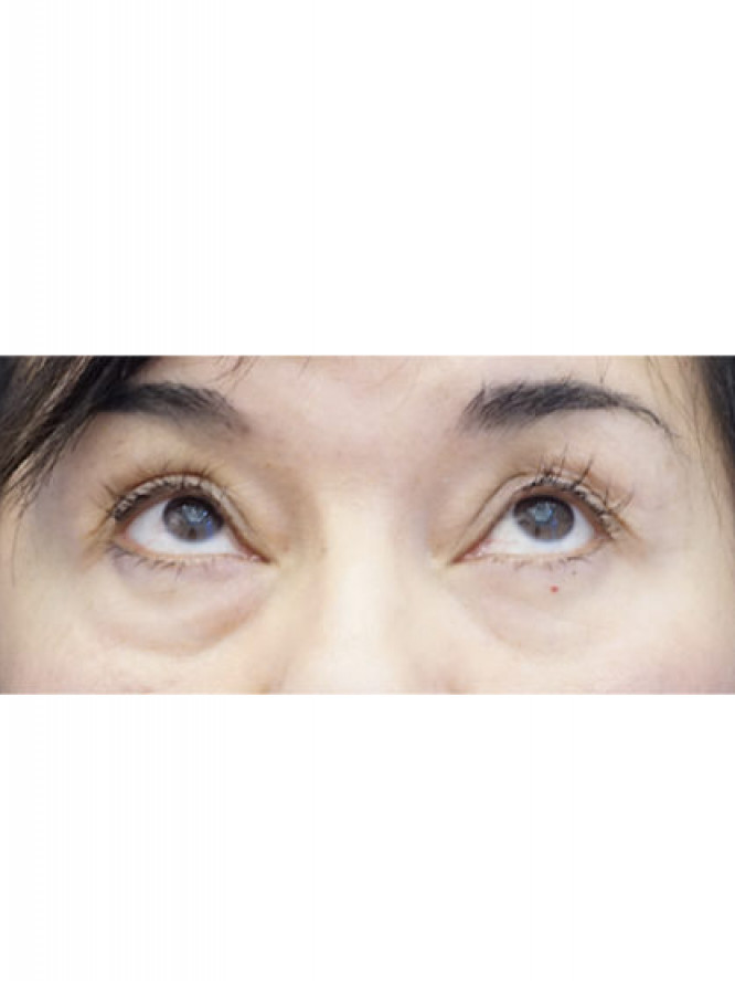 Four Quadrant Blepharoplasty with Fat Reposition — Before