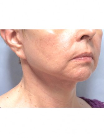 Neck Lift* — After