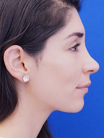 Nasal Bridge Bump* — After