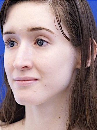 Nasal Profile Irregularity — Before