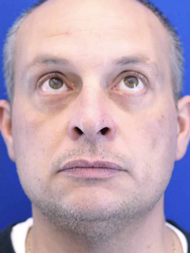 Orbital Fat Reposition — After
