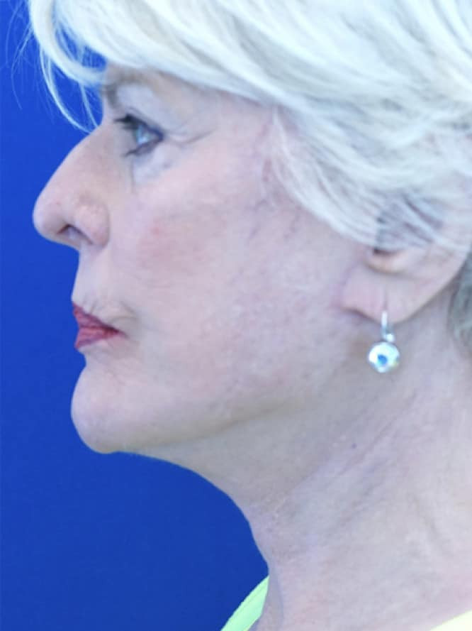 Deep Plane Lift and Platysmaplasty — After