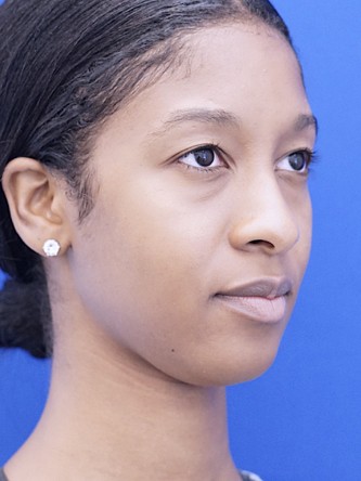 Ethnic Rhinoplasty* — Before