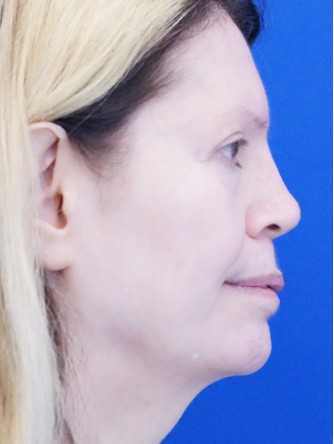 Sunken Nasal Base and Upper Lip* — After