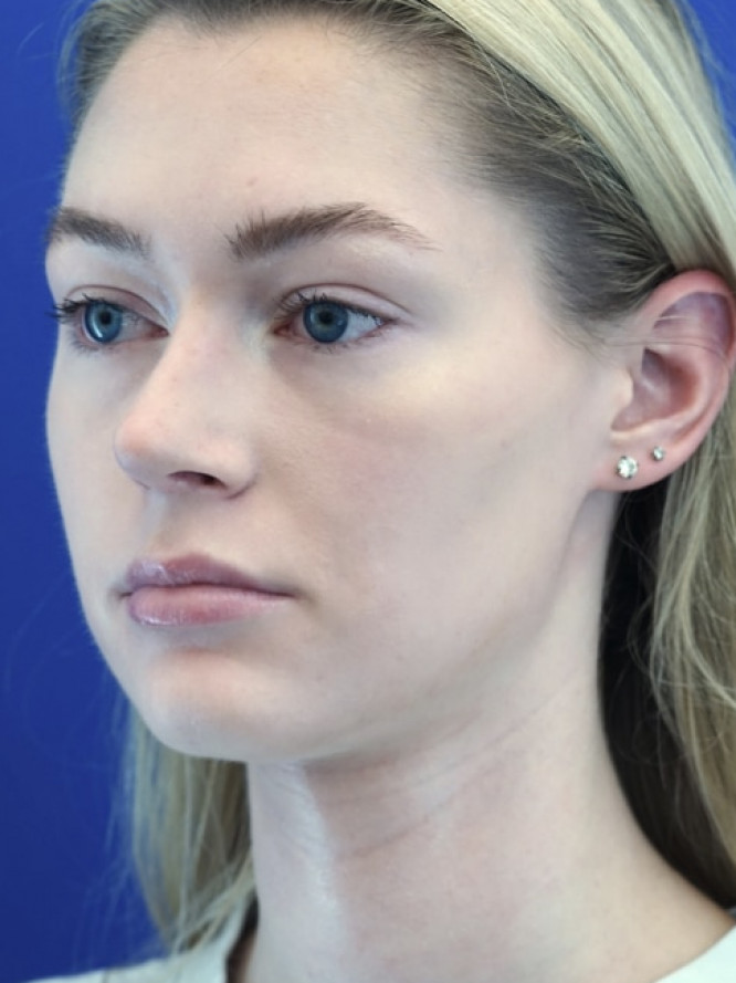 Nasal Profile Plasty — After