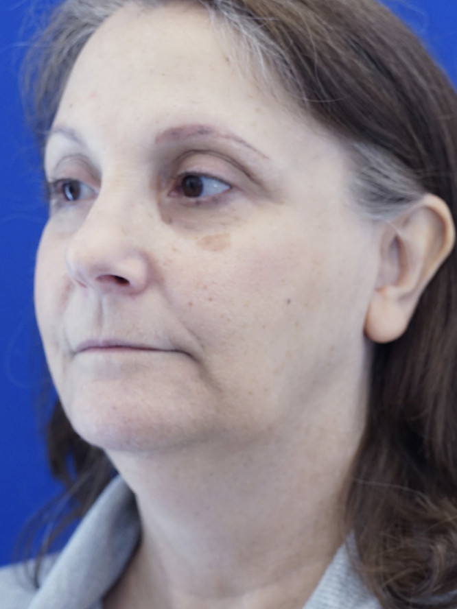 Deep Plane Facelift and Platysmaplasty — Before