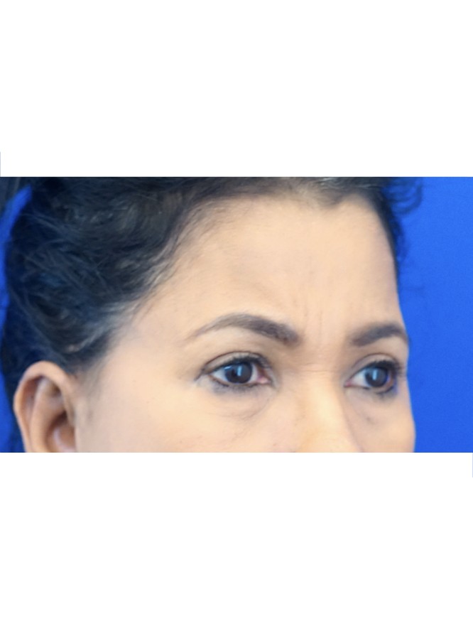 Endoscopic Forehead Lift — After