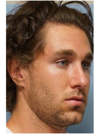 Crooked Nose & Dorsal Hump2* — After